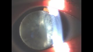 C5 cortical cataract surgery synergy toric IOL [upl. by Arad458]