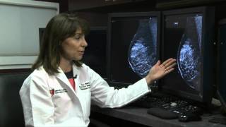 2D vs 3D Mammography [upl. by Cowley]