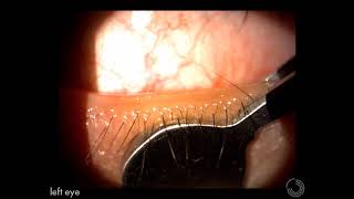 Meibomian gland expression EXPLAINED [upl. by Asserat156]