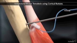 Subpectoral Biceps Tenodesis Using Cortical Buttons [upl. by Tenenbaum]