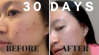 30 DAYS Aztec Secret Healing Clay Mask RESULTS [upl. by Luella435]