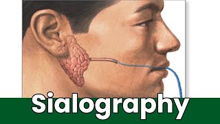 What Is Sialography Overview Uses And The Procedure How Is Sialography Done [upl. by Hillell]