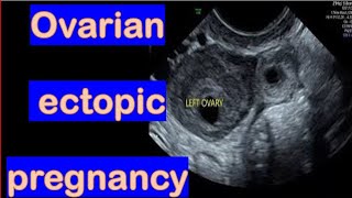 Ultrasound Diagnosis Of Ovarian Ectopic Pregnancy [upl. by Laefar]