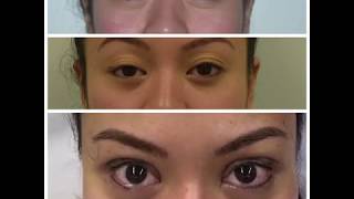 ChaseLayMD Asian Eyelid Surgery Anchoring Technique and Ptosis Repair [upl. by Hewitt]