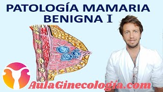 PATOLOGÍA BENIGNA DE MAMA I QUISTES MASTOPATÍA FIBROQUÍSTICA y otros  Ginecología y Obstetricia [upl. by Nilecoj]