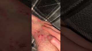 short video of foot scratching eczema asmr [upl. by Frederique482]