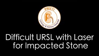 Difficult URSL with Laser for Impacted Stone [upl. by Eedna]