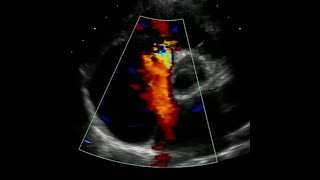 Atrial Septal Defect Pre and Post Amplatzer Device Closure [upl. by Ataga]