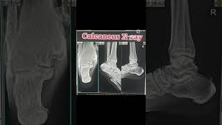 X ray calcaneus axial only lat view anatomy X ray [upl. by Tenay567]