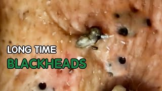 Blackheads Removal Acne Hidden For a Long Time [upl. by Enneicul188]