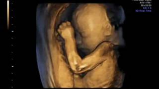 3D ultrasound 25 weeks 4D view of baby 25 week pregnancy baby girl first view [upl. by Einnov183]