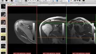 Systematic Interpretation of Shoulder MRI How I do it [upl. by Niamjneb]