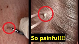 Painful and satisfying ingrown hair compilation  Best TikTok trending content [upl. by Amees]