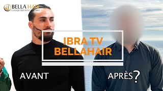 GREFFE de BARBE pour IBRA TV greffedecheveux hairtransplant2022 ibratv [upl. by Kahlil]