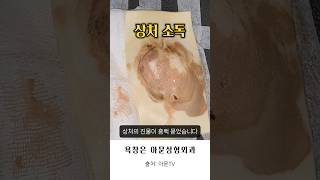 진물이 너무 많아요 대퇴부 골반 욕창 감염 소독 치료 드레싱 병원 항생제 bedsore pressure sore surgery infection seoul korea아문TV [upl. by Eekaz]