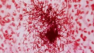 Clinical Mycology Direct Examination Series Nocardia Hot Topic [upl. by Woodhead]