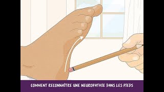 Comment reconnaître une neuropathie dans les pieds [upl. by Mirna]