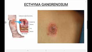 Ecthyma Gangrenosum [upl. by Llewon]