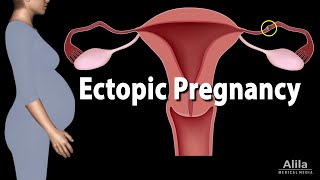 Ectopic Pregnancy Animation [upl. by Ynatil52]