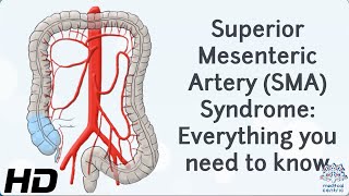 From Diagnosis to Recovery A Journey through Superior Mesenteric Artery Syndrome [upl. by Eilrahs904]