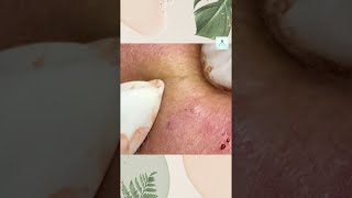 Big Cystic Acne Blackheads Extraction Blackheads amp Milia Whiteheads Removal Pimple Popping Shorts [upl. by Kemble]