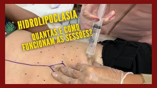 Como é feita a hidrolipoclasia [upl. by Elvira631]