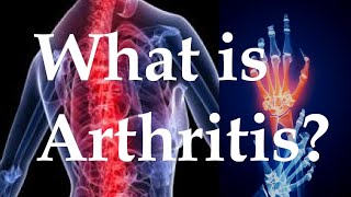 What is arthritis [upl. by Oinotnas938]