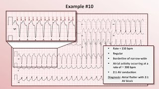 Intro to EKG Interpretation  Practicing Tachyarrhythmia Identification [upl. by Aihsem]