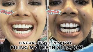 Filing roundchipped teeth straight enameloplasty amp inbrace lingual braces removal day [upl. by Schnur]