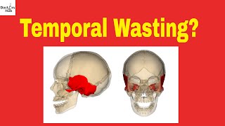 Cancer Wasting  Temporal Wasting  Wasting Syndrome  Malignant Cachexia [upl. by Elokkin]