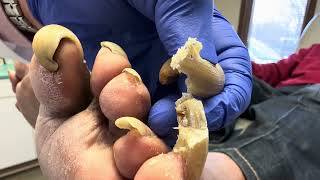 Unbelievable Toenails so long and painful that patient cannot walk [upl. by Evvie]