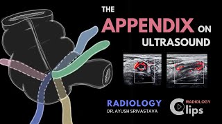 The Appendix on ultrasound and Acute appendicitis  Radiology [upl. by Yregram866]