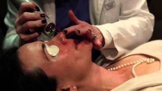 Laser treatment for Rosacea Birmingham Alabama  Cosmetic Dermatology [upl. by Aiderfla]