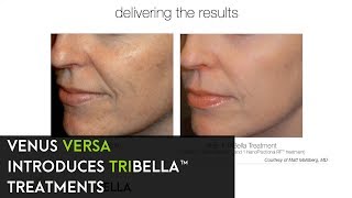 TriBella™ Treatments by Venus Versa™ [upl. by Euqinahs]