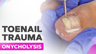 Toenail Trauma  Onycholysis  Cleanup [upl. by Timms]