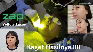 Yellow Laser Zap Clinic Hasilnya Wow [upl. by Leyes85]