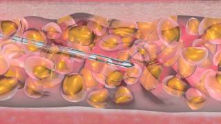 Animation WaterjetAssisted Liposuction  wasserstrahlassistierte Liposuktion WAL [upl. by Esinrahs]