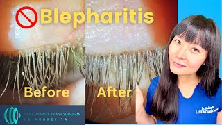 Best Blepharitis Treatments at Home  Simple amp Effective  Step by Step Guide Eye Surgeon Explains [upl. by Elidad792]