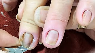 Inflamed Nails Need to Remove Corners Pick Dead Skin Nail Spa [upl. by Trainer302]