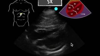 POCUS Teaching Point Pericardial effusion [upl. by Shatzer]