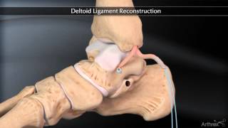 Deltoid Ligament Reconstruction [upl. by Urbannal727]