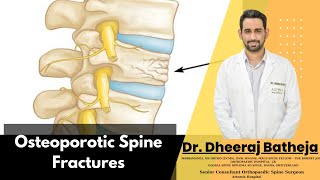 Transform Your Understanding of Osteoporotic Spine Fractures with Dr Dheeraj Batheja [upl. by Lorien]