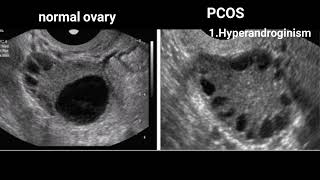 GAME  15  Serous and Mucinous Cystadenoma Ovary  Dr G Shivashekar  Practical Pathology [upl. by Nani]