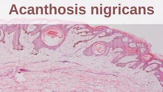 Acanthosis Nigricans  Pathology mini tutorial [upl. by Ratib]