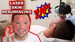 Laser Skin Resurfacing  Getting Fractional C02 Laser Procedure for Acne Scar Removal [upl. by Idnib]