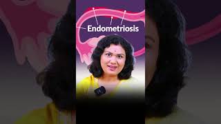 Endometriosis को कंट्रोल करने के Natural Tips और Fertility Diet shorts prernasfertilitycare [upl. by Nirhtak135]