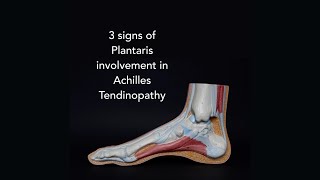 3 signs of Plantaris involvement in Achilles Tendinopathy with Tom Goom [upl. by Anahsor]