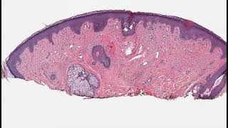 fibrous papule of the nose [upl. by Nwhas732]