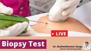 Live Biopsy Test  How Biopsy Test is Done  biopsy test kaise hota hai [upl. by Hsotnas]