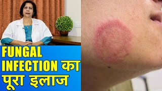 फंगल इन्फेक्शन का पूरा इलाज  Complete Treatment of Fungal Infections [upl. by Irrol]